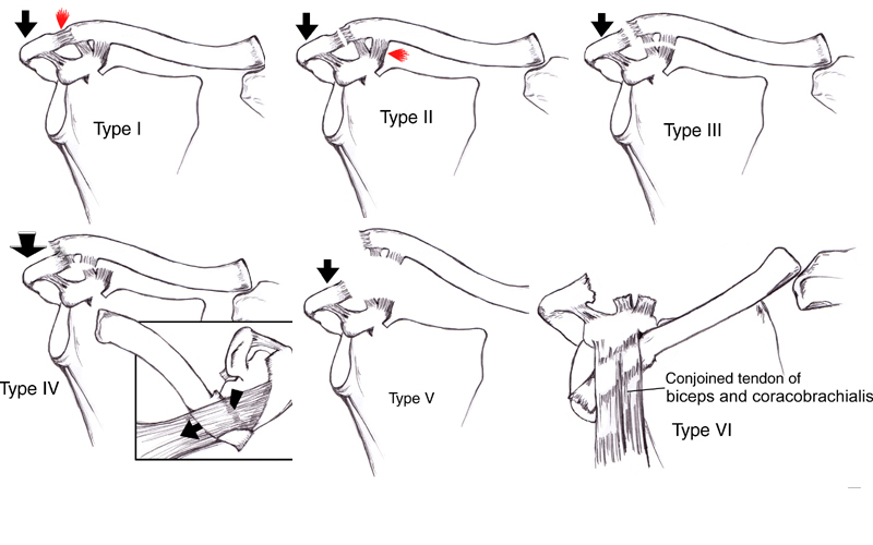 acromio-clavicular-injuries-ac-separation